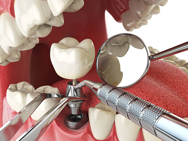 Best Emergency Dental Care for Abscessed Tooth in Carbondale, IL