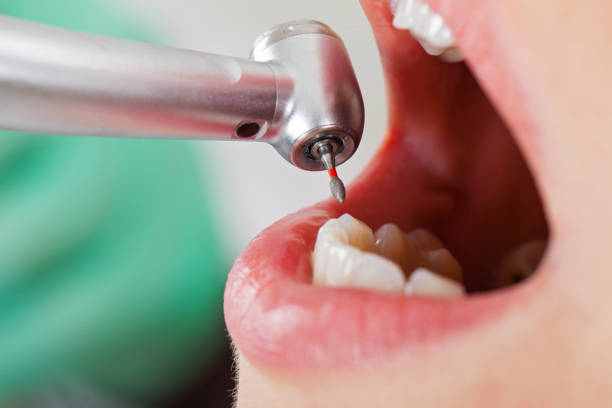 Best Emergency Dentist for Lost Fillings or Crowns in Carbondale, IL